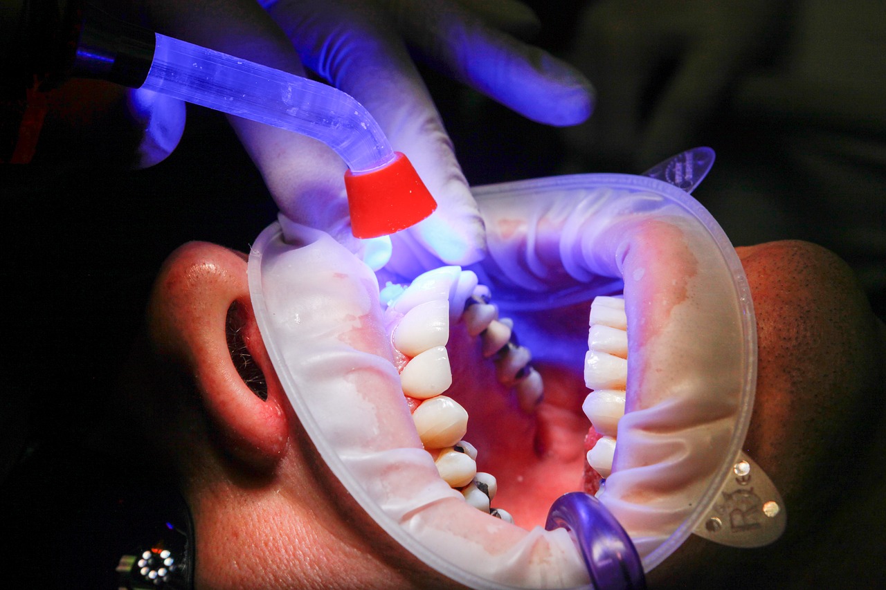 dentist, facet, uv light-1864921.jpg